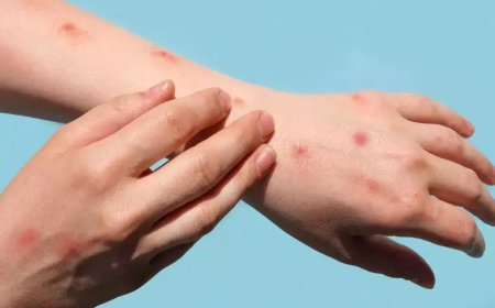 ମଙ୍କି ପକ୍ସ ପାଇଁ ନିର୍ଦ୍ଦେଶାବଳୀ ଜାରି