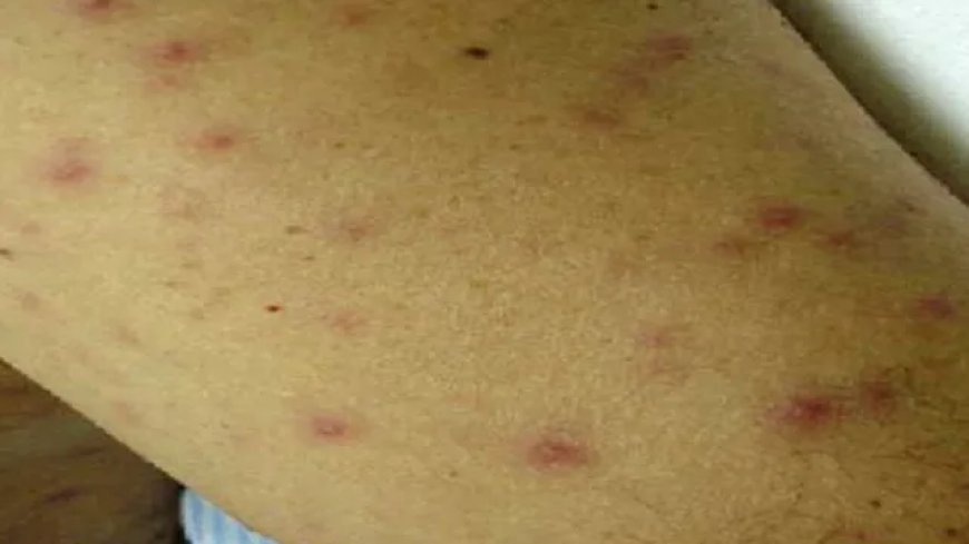ଅନୁଗୋଳରେ_ସ୍କ୍ରବ୍_ଟାଇଫସ୍